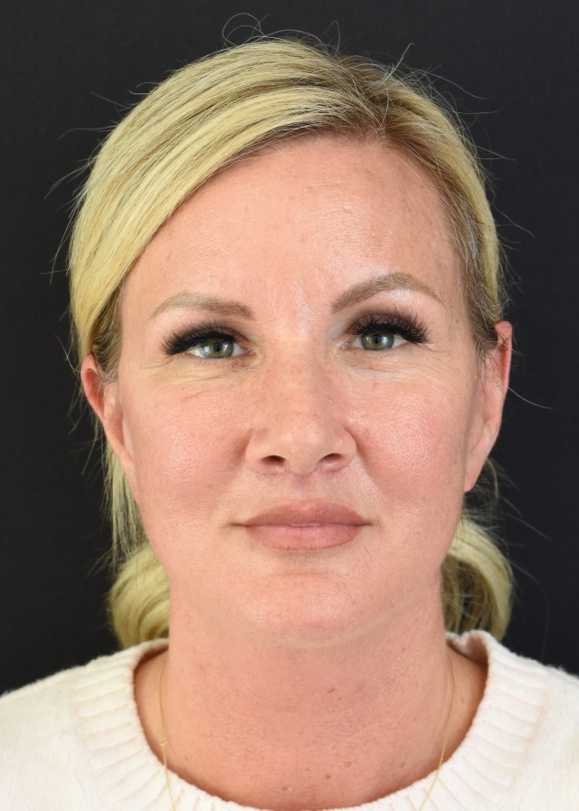 Extended Deep Plane Facelift Patient 44 Set 1 After